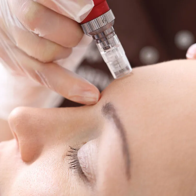 A microneedling skin rejuvenation treatment in progress